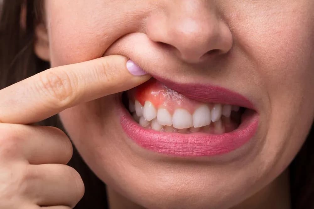 Avaliação da gengiva em tratamento periodontal