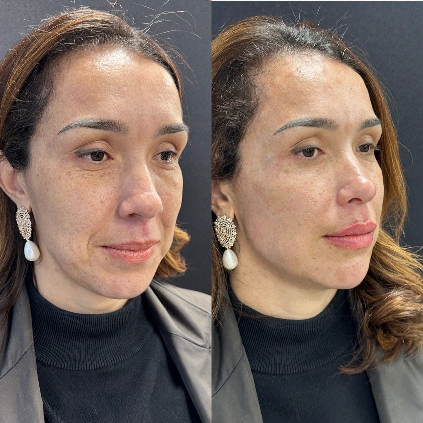 Harmonização orofacial com a Dra. Luana Gonzaga em Uberaba