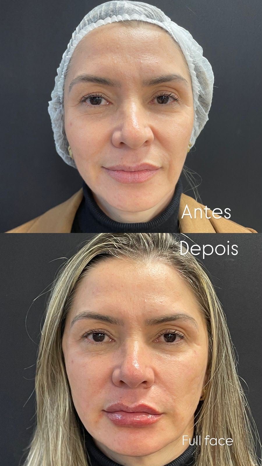 Harmonização orofacial com a Dra. Luana Gonzaga em Uberaba