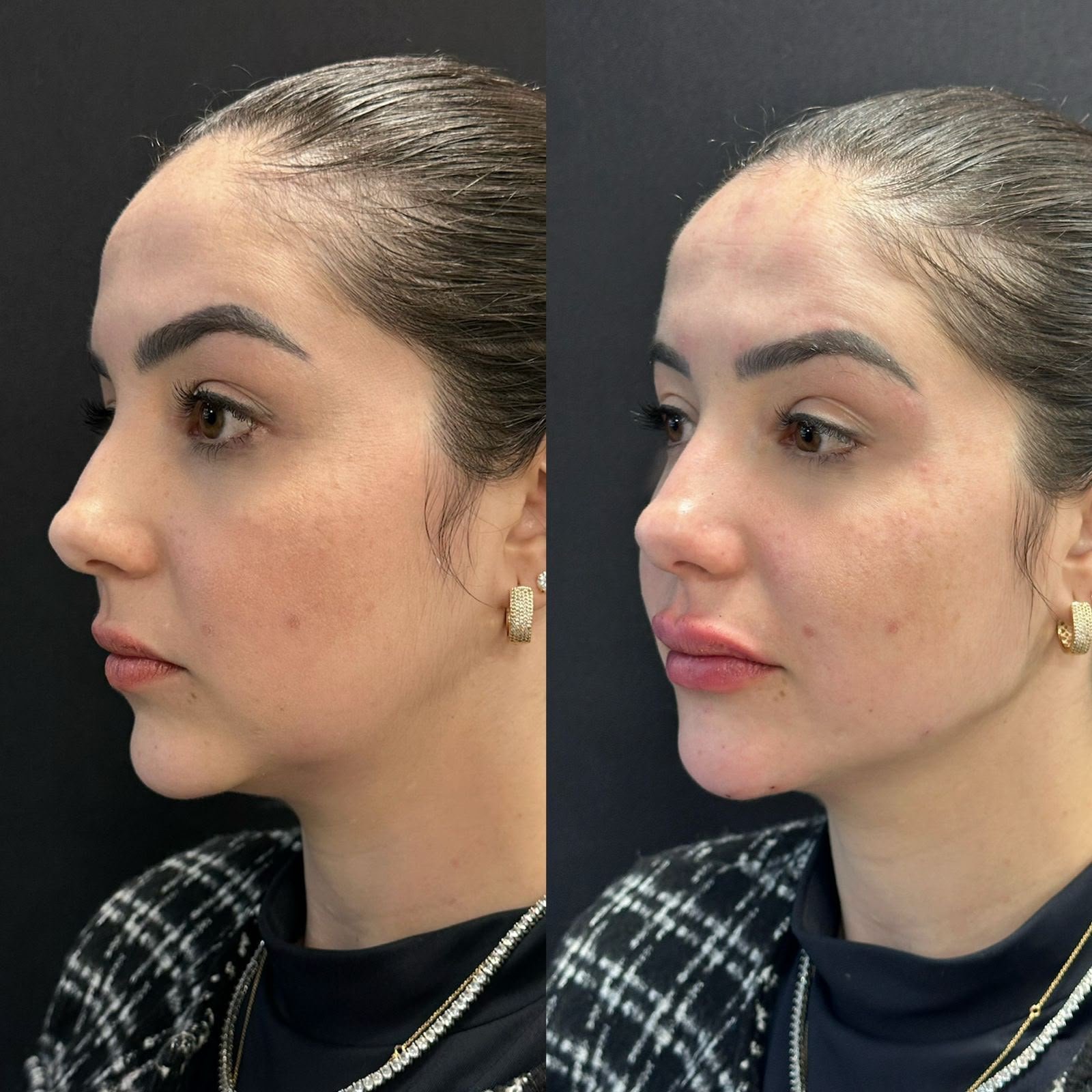 Harmonização orofacial com a Dra. Luana Gonzaga em Uberaba
