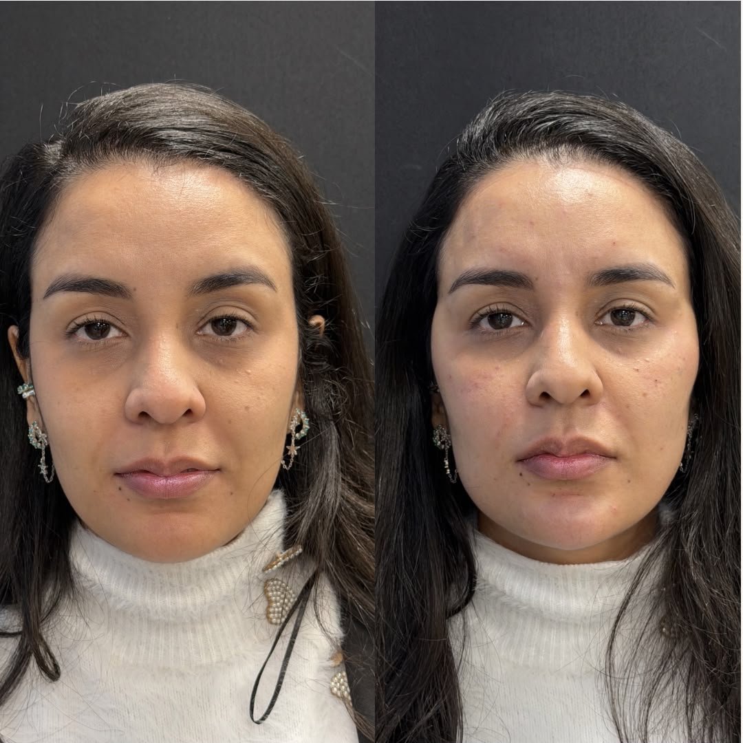 Harmonização orofacial com a Dra. Luana Gonzaga em Uberaba