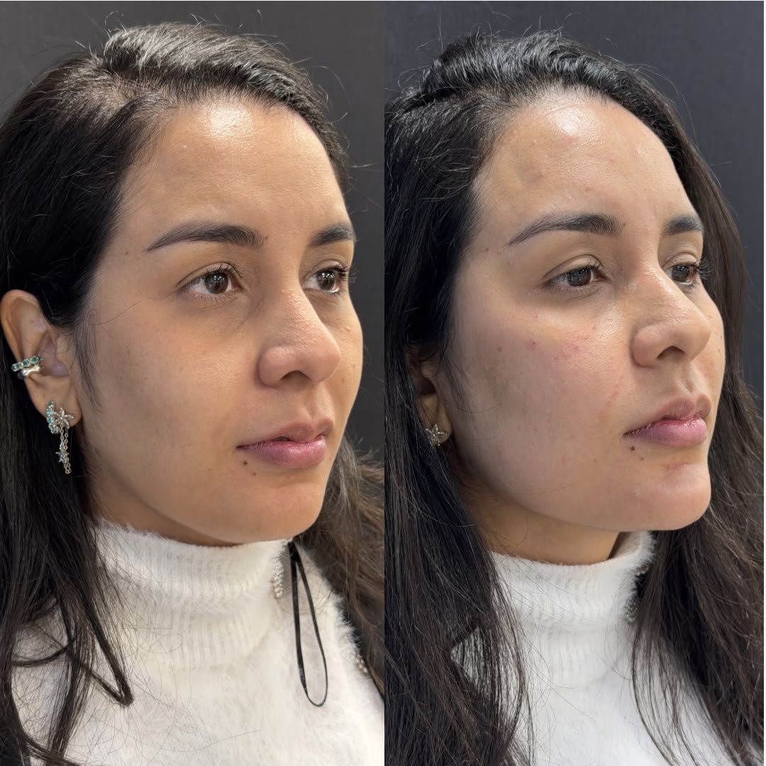 Harmonização orofacial com a Dra. Luana Gonzaga em Uberaba