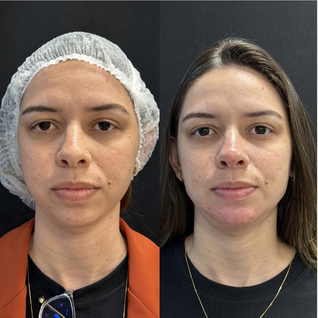 Harmonização orofacial com a Dra. Luana Gonzaga em Uberaba