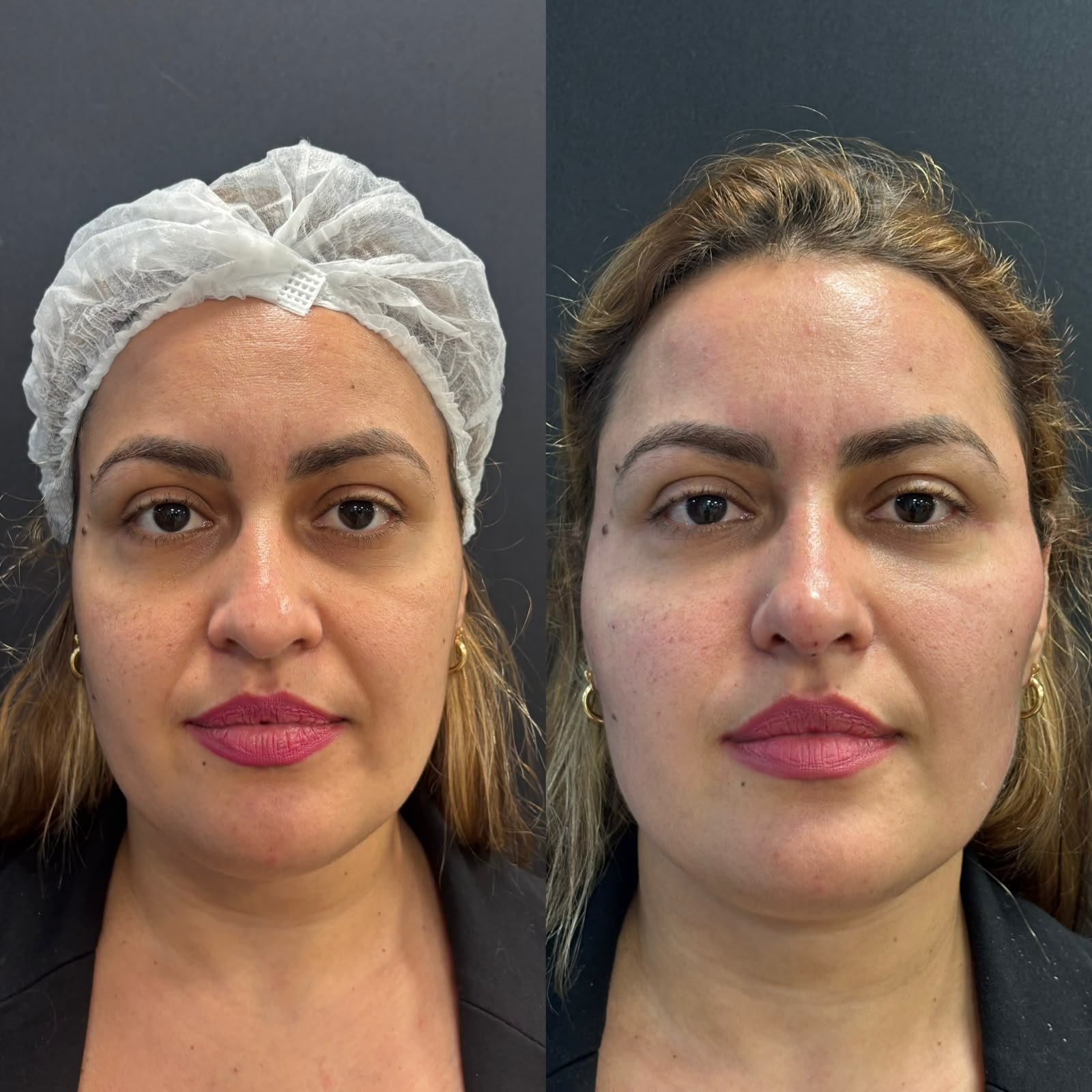 Harmonização orofacial com a Dra. Luana Gonzaga em Uberaba