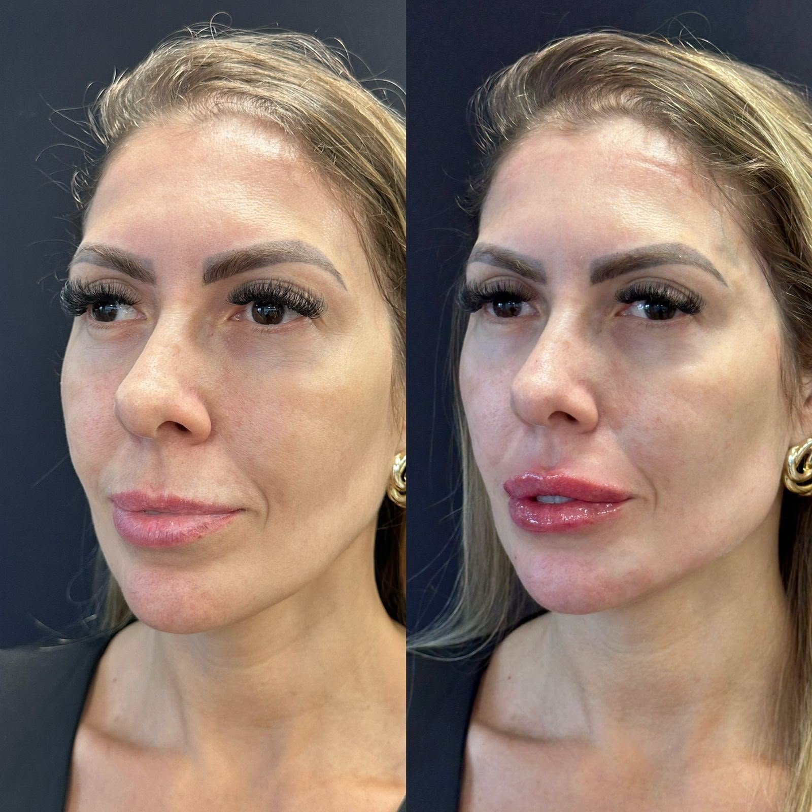 Harmonização orofacial com a Dra. Luana Gonzaga em Uberaba