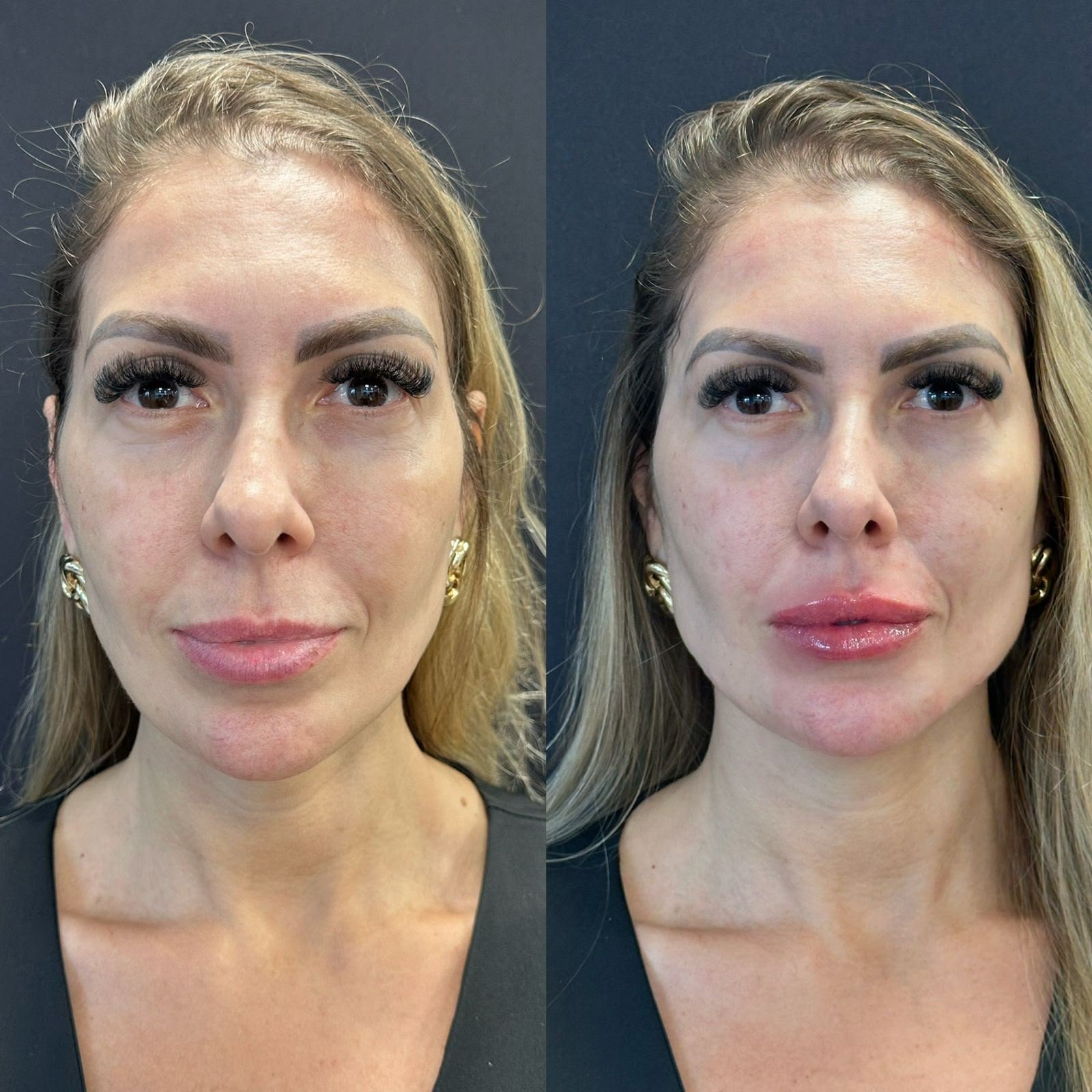 Harmonização orofacial com a Dra. Luana Gonzaga em Uberaba