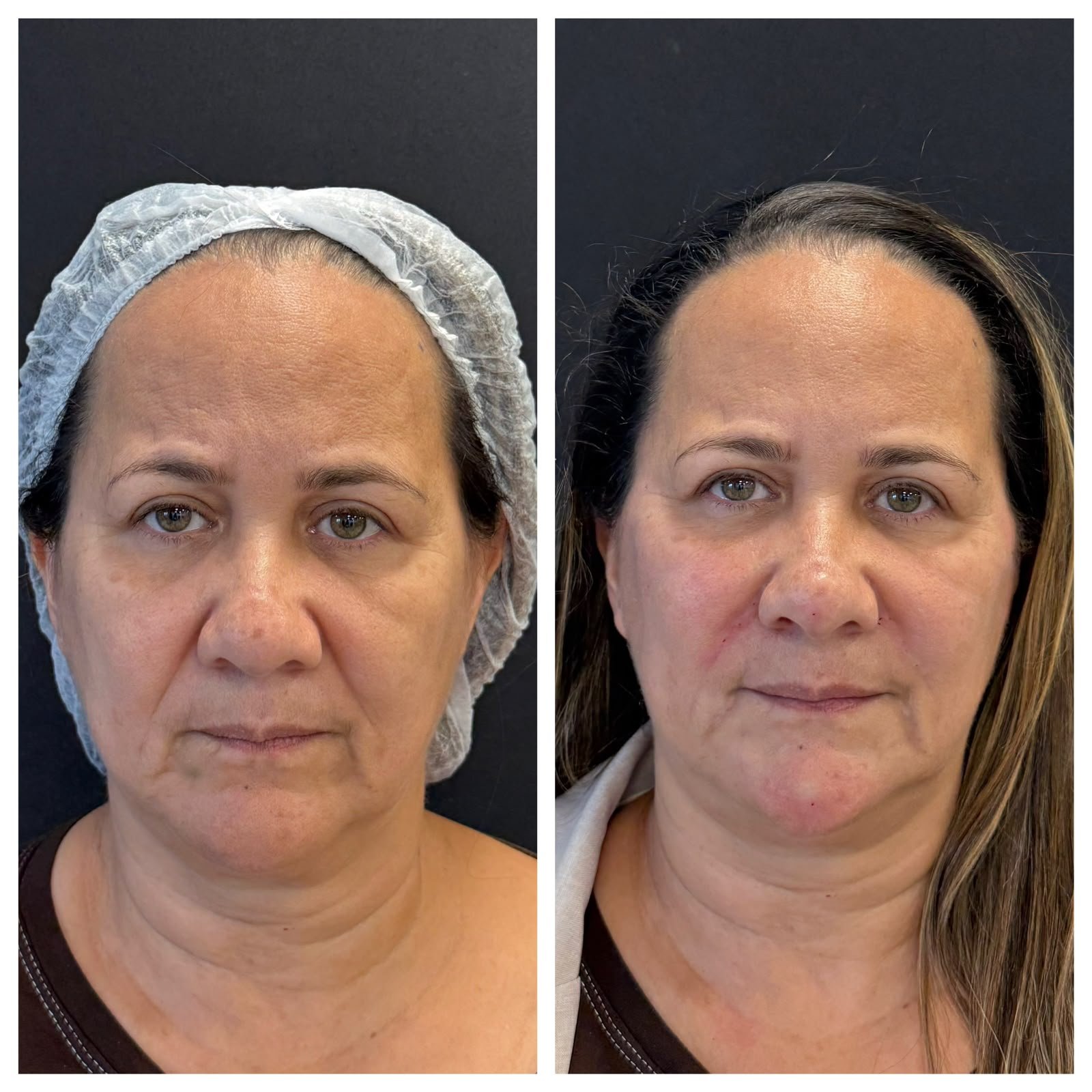 Harmonização orofacial com a Dra. Luana Gonzaga em Uberaba