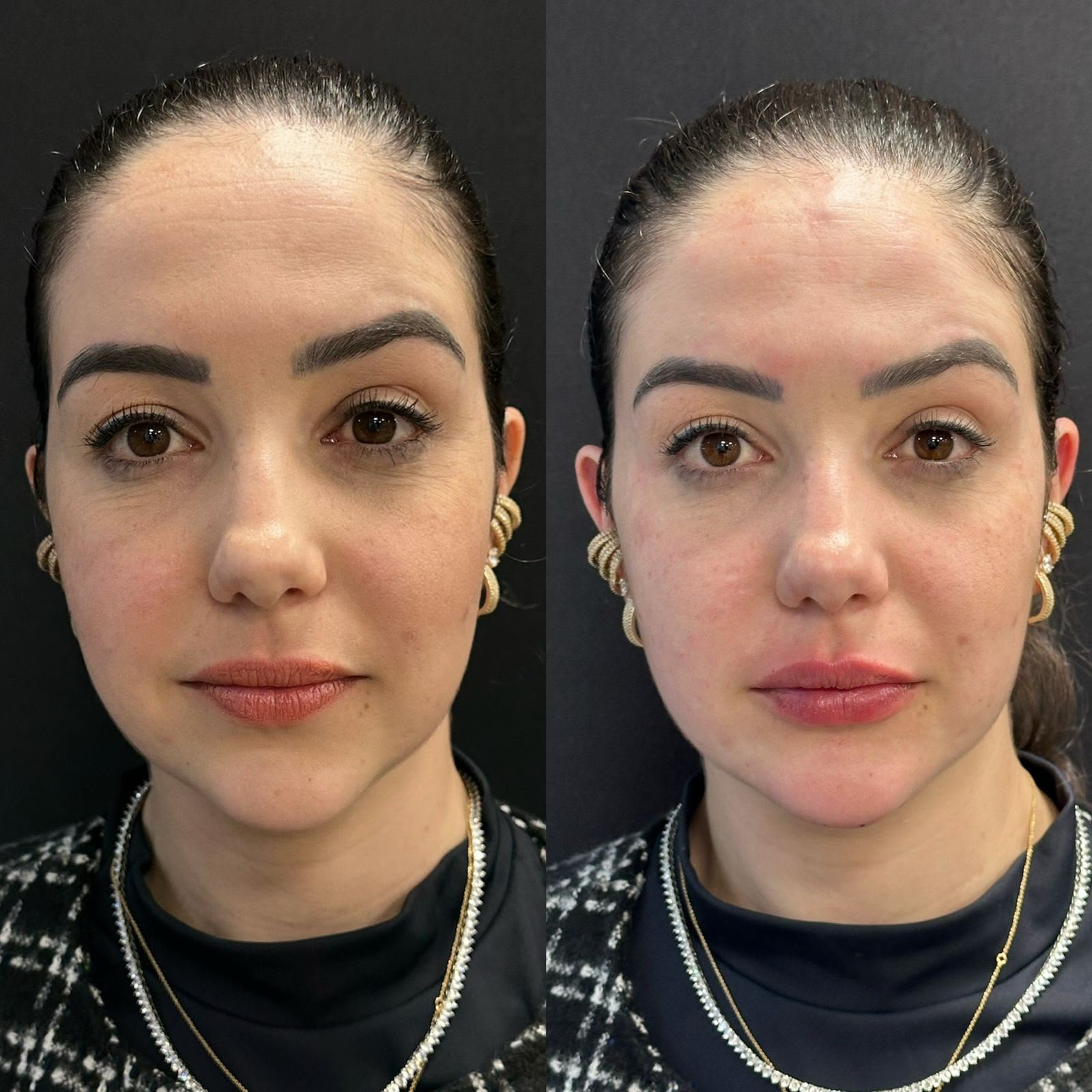 Harmonização orofacial com a Dra. Luana Gonzaga em Uberaba